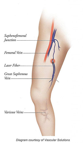 Medical illustration showing a laser fibre positioned in the great saphenous vein